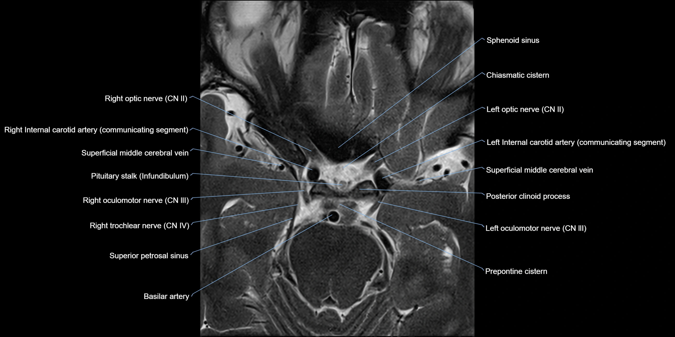 MRI cavernous sinus axial cross sectional 3T anatomy image-img-11001-00014.webp